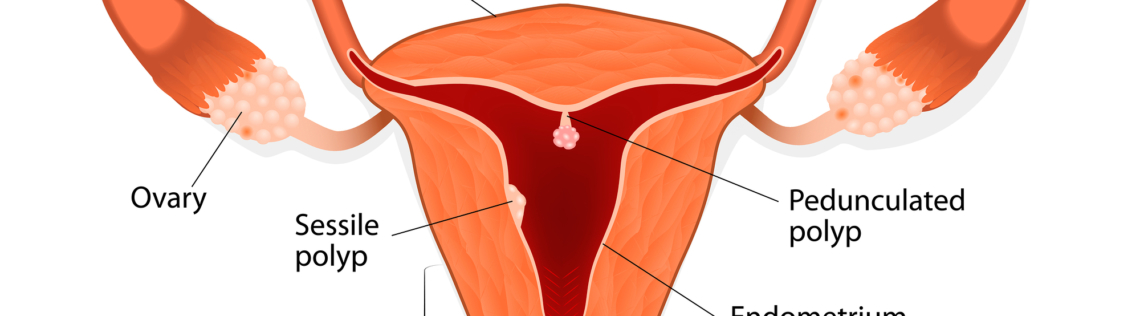 bigstock Endometrial polyp or uterine p 76682927