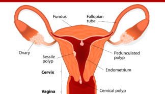 bigstock Endometrial polyp or uterine p 76682927